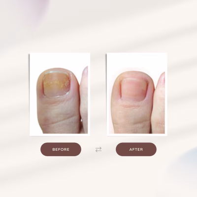 Crema Anti Hongos Uñas Crema de Pies Hidratante Anti Olor Pies con Aceite de Árbol de Té Potente Anti fungal Crema Anti Hongos Uñas Crema de Pies Hidratante Anti Olor Pies con Aceite de Árbol de Té Potente Anti fungal