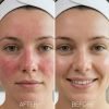 cuidado facial reafirmante piel sensible aceite esencial romero antirosacea antirojeces hidratación tratamiento profesional after before cuidado facial reafirmante piel sensible aceite esencial romero antirosacea antirojeces hidratación tratamiento profesional after before